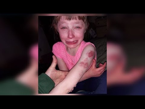 10-year-old girl with special needs ‘brutally’ bitten on school bus, parents say