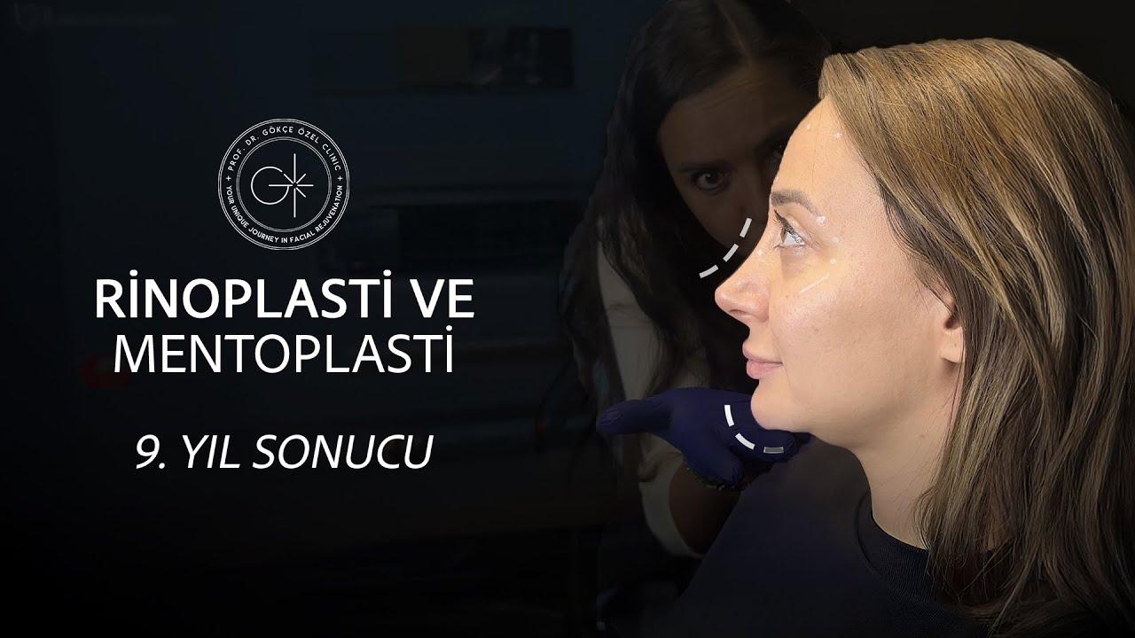9 YILLIK RİNOPLASTİ VE MENTOPLASTİ SONUCU I DOĞAL GÜZELLİĞİN DÖNÜŞÜMÜ! #rinoplasti #mentoplastia