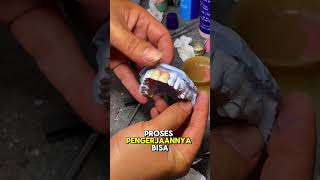 Download lagu Good and Comfortable Acrylic Dentures mp3 Download lagu Good and Comfortable Acrylic Dentures mp3