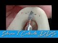 How To Make A Nightguard Dental Minute With Steven T Cutbirth DDS