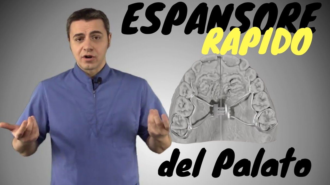 Espansore Rapido del Palato