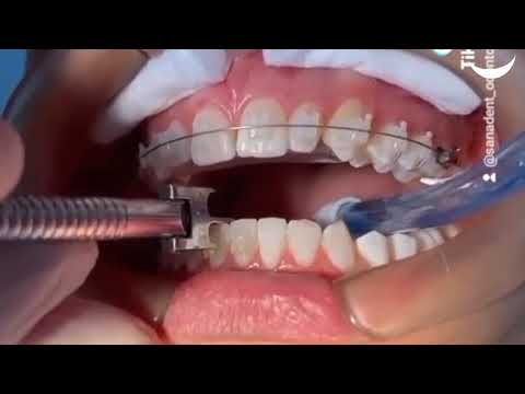 Montaje de brackets cerámicos