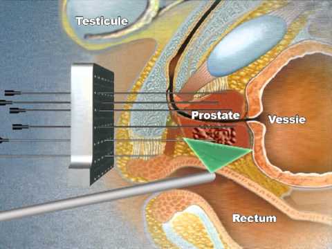 Belarusian Medikamente von Prostatitis Kompatibel Bad und BPH
