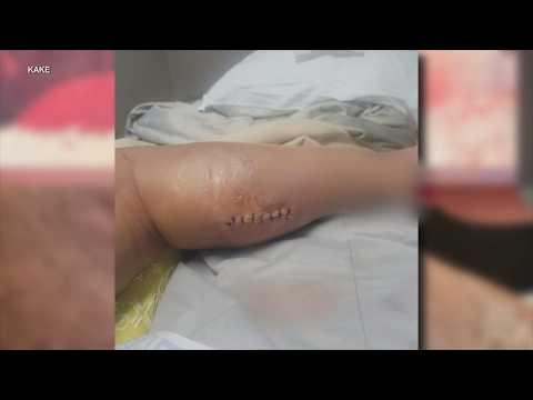 Mom says she was given days to live after spider-bite nightmare