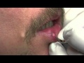 Venous Lake of Lip and Lip Freckle Removal with ...