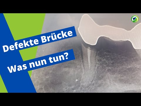 Defekte Brücke - Was kann ich nun tun? - ein Patientenfall - Varianten für neuen Zahnersatz