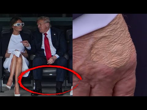 What Is That Spot on President Trump's Hand?