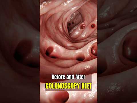What to Eat Before and After a Colonoscopy 🥣 | Colonoscopy Prep Guide! #Colonoscopy #healthtips