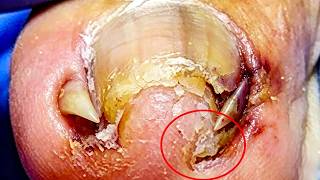 Extremely Curled Toenails, Deeply Ingrown Nail Beds【Xue Yidao】
