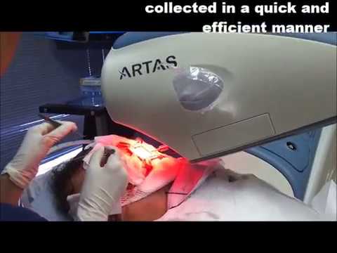 ARTAS Robot Assisted FUE Hair Transplant at Limmer...
