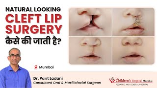 Cleft Lip and Palate Surgery which looks Natural by Dr. Parit Ladani