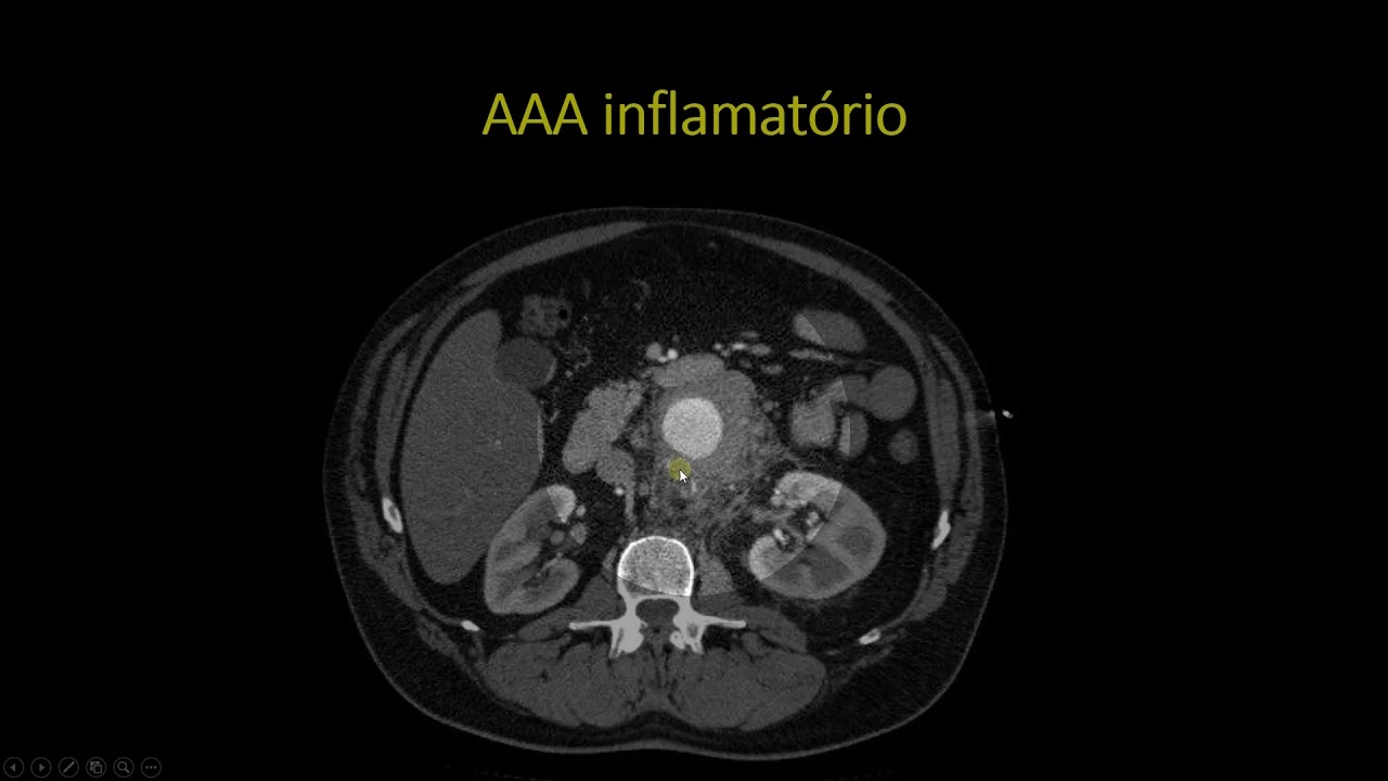 Aneurisma inflamatório da aorta abdominal