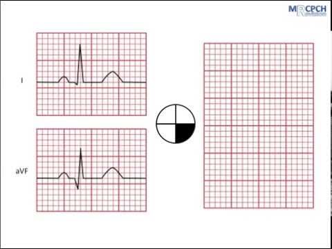 Working out the QRS axis on an ECG