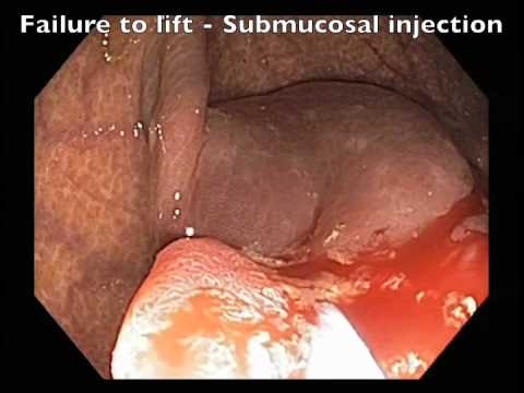 A Sign of Submucosal Invasion After Failed Lifting