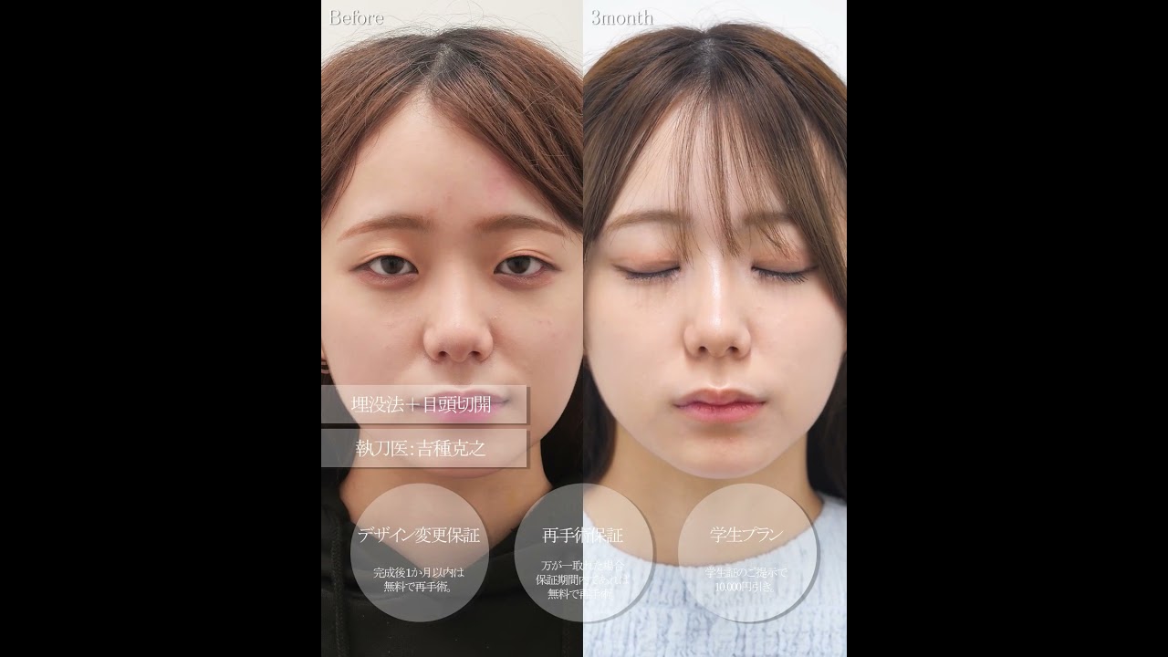 二重埋没法✖️目頭切開