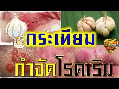 ลาเหยียบคิดเห็นจากกลาก ไขมันแบดเจอร์และการรักษาของโรคสะเก็ดเงิน
