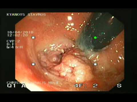 Excision Of Polyp In Rectum