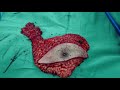 Teknik Operasi Modified Radical Mastectomy