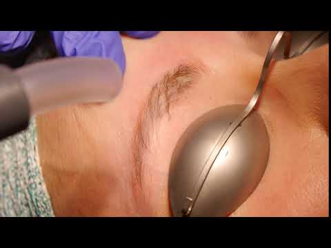 Microblading-Entfernung mit dem Laser