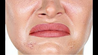 Emergency Skin Fixes for Oily Skin, Scabby Pimples, Dermatitis + Dry Flaky Skin | Ruby Golani