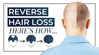 How To Reverse Hair Loss | Treatment, DHT Blocking Shampoo, Medication