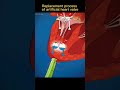 process of artificial heart