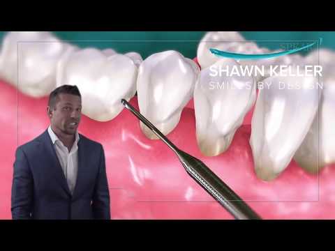 Bone Loss Around Your Teeth | The Real Cause Will Shock You | The Side Effects Are DEADLY