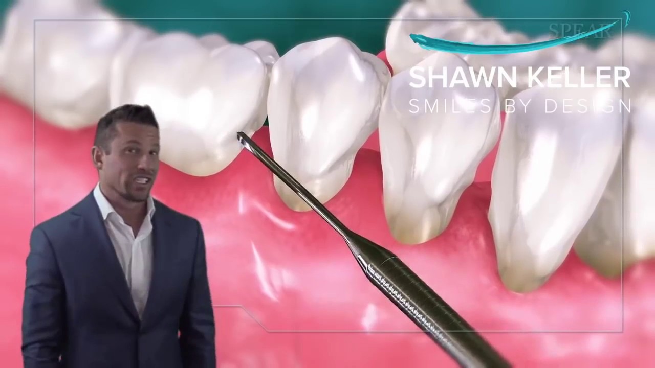 Bone Loss Around Your Teeth | The Real Cause Will Shock You | The Side Effects Are DEADLY