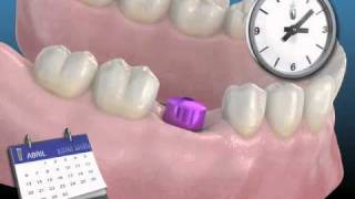 Los implantes dentales - Centros Dentales Unidos Getafe