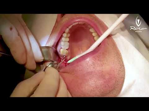 IDR - Immediate Dentoalveolar Restoration FULL Case - Brazil Oct-2020