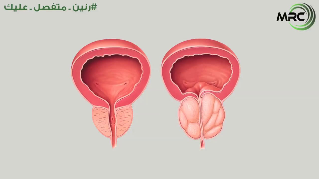 الرنين المغناطيسي (MRI) أحدث بروتوكول لتشخيص سرطان البروستاتا!