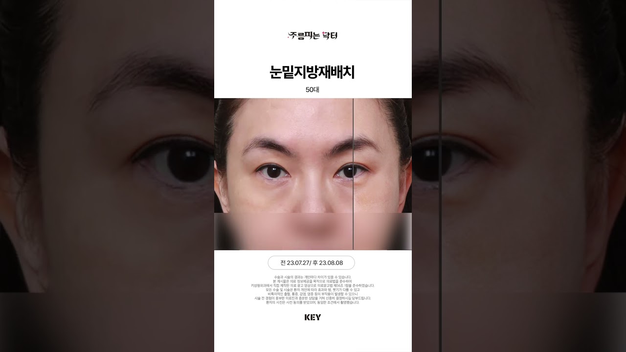 50대 눈밑지방재배치 대구키성형외과