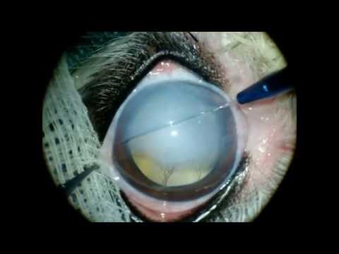 Gundersen Flap in severe corneal edema