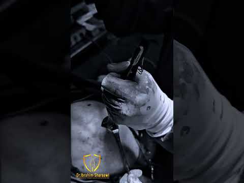 نجاح عملية اصلاح قطع وتر الكتف بالمنظار مع دكتور ابراهيم شعراوي