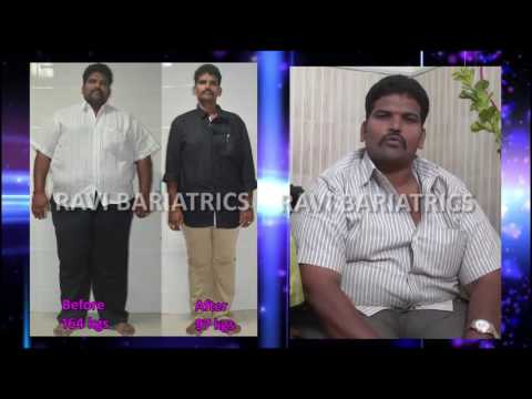 bariatric surgery for miraculous weight loss. dr ravikanth kongara, hyderabad, vijayawada.