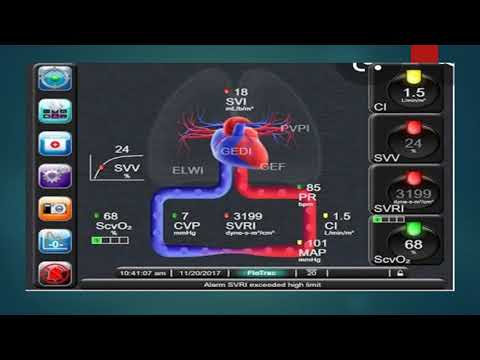 Parâmetros de Alguns Monitores de Hemodinâmica em UTI - Se inscreva e Assista a Vários Vídeos de UTI