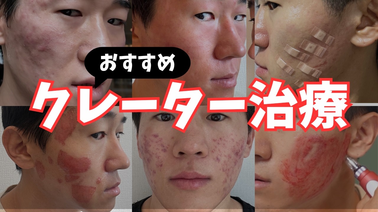 【総額300万円】本気のおすすめクレーター治療とは？【治療歴5年】