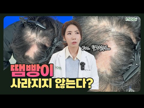 [EN][JP]흉터성 탈모(땜빵)에 모발이식을 한다면 생착이 잘 될까요⁉️????