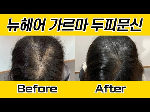 여자 가르마 두피문신 시술 전후 I 뉴헤어 SMP I 두피문신 I 탈모치료 I Before&After