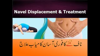 Navel Displacement Treatment | Belly Button Problems | Naaf Talna | Urdu/English