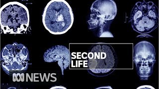 New drug to treat Alzheimer&#39;s Disease could prove game-changer | ABC News