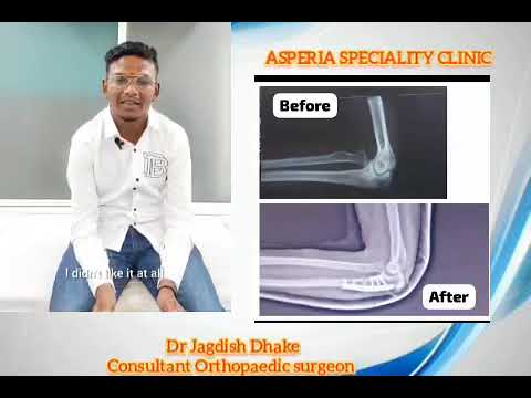 Chronic radial head dislocation surgery by Dr Jagdish Dhake