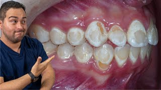 CARIES DENTAL POR BRACKETS ¡CUIDADO CON ESTAS MANCHAS BLANCAS SI TIENES ORTODONCIA!