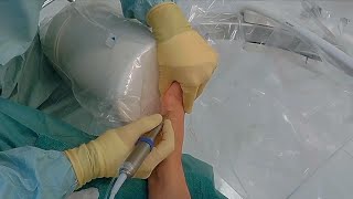 New Less Invasive Bunion Surgery?