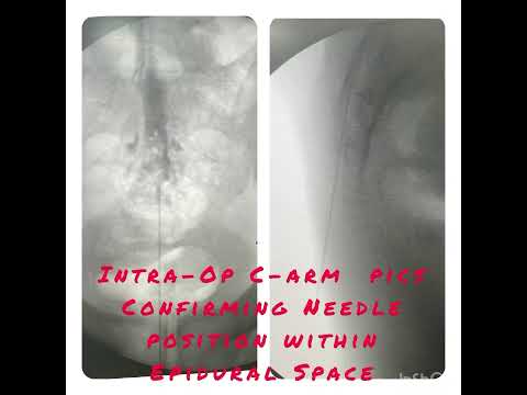 Disc Prolapse | SCIATICA | Epidural Steroid Injection | Spine Surgery | Dr.Sudheer Pothu