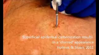 Electrodesiccation and curettage | Electrosurgery