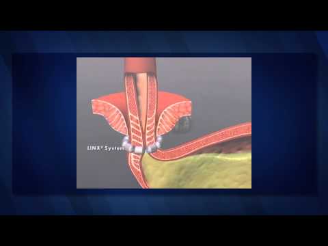 The LINX Procedure for GERD with Dr. Preeti Malladi: Brad's Story