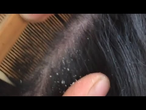 Dandruff Removal / Dandruff Extreme / Dandruff Scratching ASMR /  Dandruff Treatment at Home #55