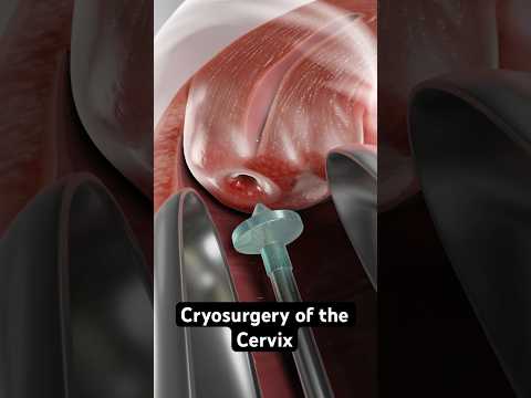 Freezing abnormal cells to prevent cervical cancer (3D Animation)