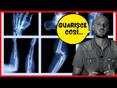 ✔️ Come guariscono le fratture | Callo osseo e guarigione primaria